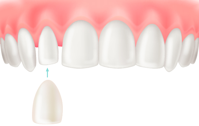 貼るだけベニア